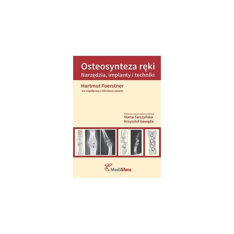 Osteosynteza ręki Premium